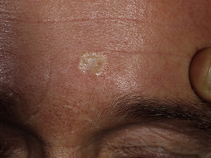 Basal Cell Carcinoma - PubMed Central (PMC)